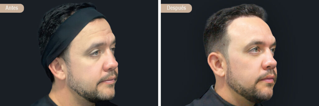 Antes y despues Botox para hombre